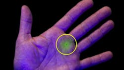 FluidSafe confirms a fluid injection injury by its bright fluorescent glow under blue light minimizing surgical intervention FluidSafe confirms a fluid injection injury by its bright fluorescent glow under blue light minimizing surgical intervention